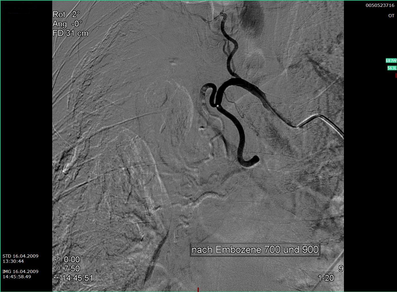 Bronchialarterie nach Embolisation