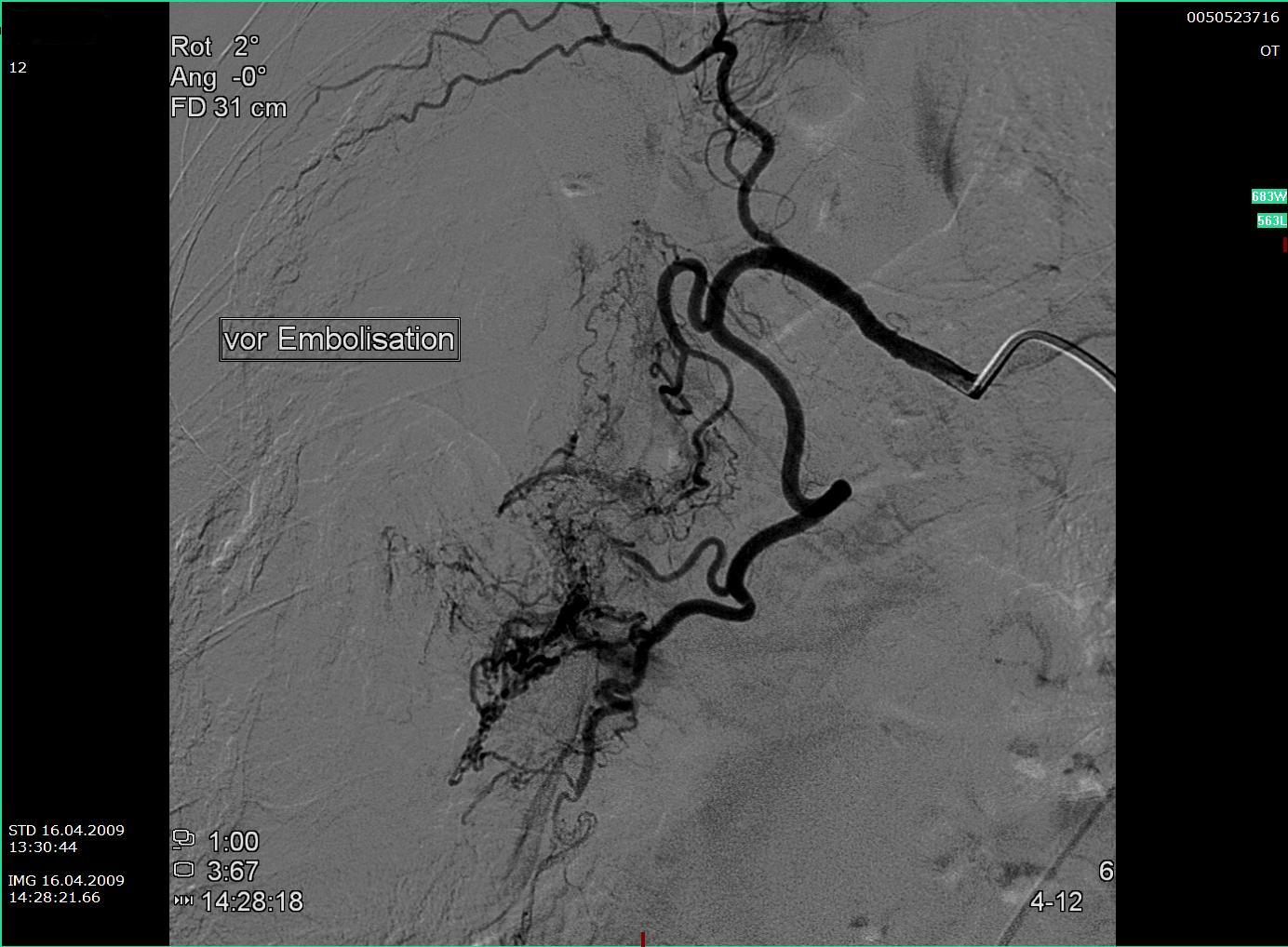 Bronchialarterie vor Embolisation