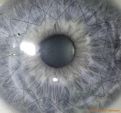 Hornhauttransplantation (Keratoplastik)