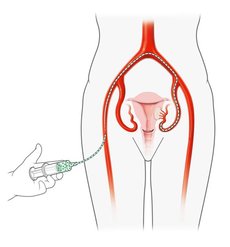 Bilder von der Embolisation: Über die Leiste ein sehr dünner Schlauch (Katheter) in die Arterie eingeführt und unter Röntgenkontrolle von einem spezialisierten Radiologen bis zur Gebärmutterarterie vorgebracht.