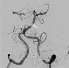 Nach Stent ist die Stenose ausgeschaltet