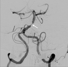 Nach Stent ist die Stenose ausgeschaltet