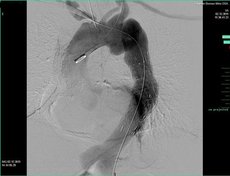 Abb. 6: Angiographische Kontrolle nach Ausschaltung des unteren Aneurysma der Brustschlagader durch eine Stent-Prothese (vgl. dazu Abb. 2).