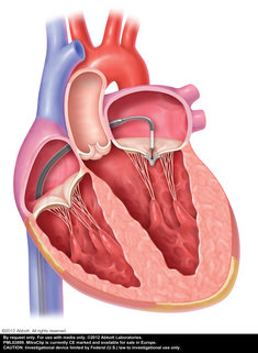 Interventionelle Mitralklappenrekonstruktion (MitraClip)