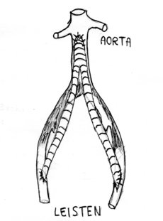 Abb. 15: Skizze einer Y-Prothese (= aorto-bi-femoral), die bei ausgedehnten Verkalkungen in der Beckenetage Verwendung findet.