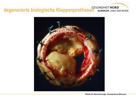 Abbildung 6: nach 15 Jahren verschlissene/verkalkte biologische Klappenprothese
