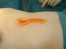 Abb. 16: Der Eingriff aus Abb. 15 wird über einen kleinen, ca. 12cm langen Schnitt an der Bauchdecke ausgeführt („Mini Laparotomie“), um die Operationsbelastung zu verringern.