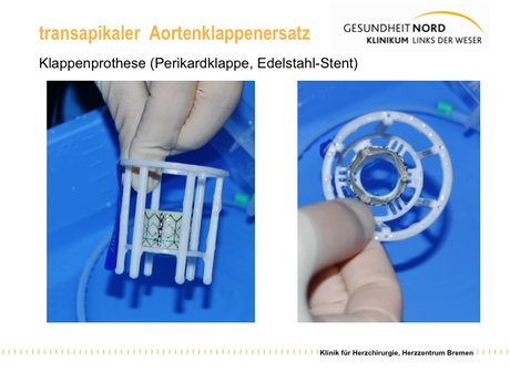 Abbildung 1: Im Stent eingenähte Klappe aus Herzbeutelmaterial (Lieferzustand)