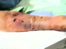 Abb. 3: Postthrombotisches Syndrom am rechten Unterschenkel Abb. 3: Postthrombotisches Syndrom am rechten Unterschenkel