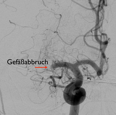 Gefäß vor Rekanalisation