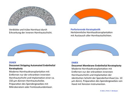 lamelläre Keratoplastik