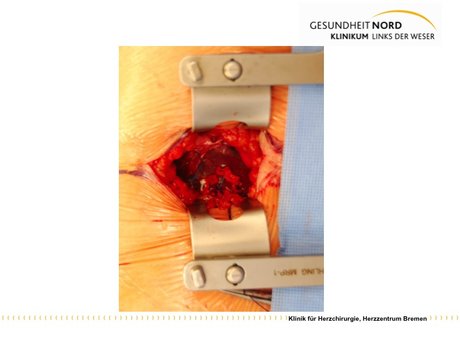 Abbildung 5: verschlossene Herzspitze nach Implantation
