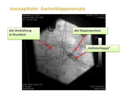 Abbildung 7: Röntgendarstellung einer „valve-in-valve“-Prozedur, wobei in die degenerierte Bioprothese eine Katheterklappe implantiert wird