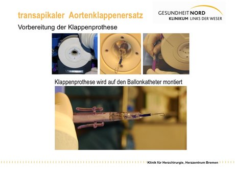 Abbildung 3: Klappenstent wird auf dem Ballonkatheter „zusammengekrempelt“, Im unteren Bildausschnitt ist die Klappe zur Implantation vorbereitet