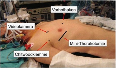 Abbildung 1: Zugänge zum Herzen bei minimal invasiver Mitralchirurgie (siehe Text).