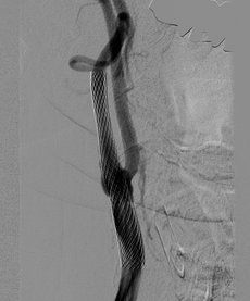 Nach Stenting ist die Stenose ausgeschaltet