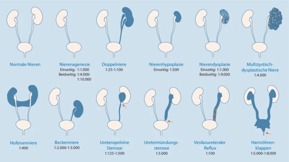 Schematische Darstellung einzelner Angeborener Fehlbildungen der Nieren und des ableitenden Harntraktes 