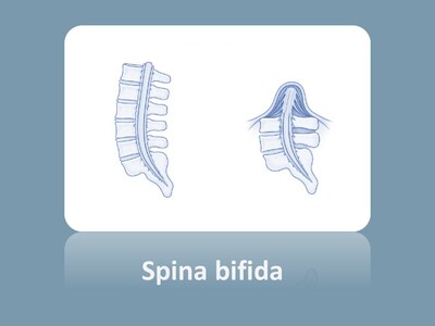 Schematische Darstellung Spina bifida