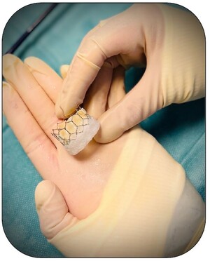 Ein TAVI-Modell ausgeklappt auf der Hand einer Ärztin