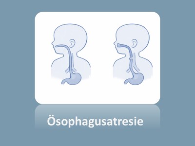 Schematische Darstellung Ösophagusatresie